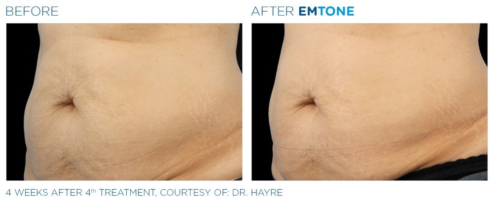 emtone cellulite before and after