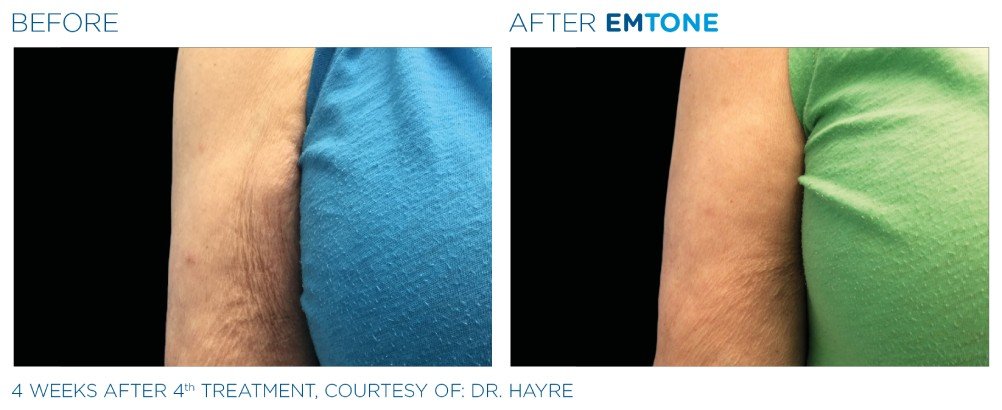 emtone cellulite before and after