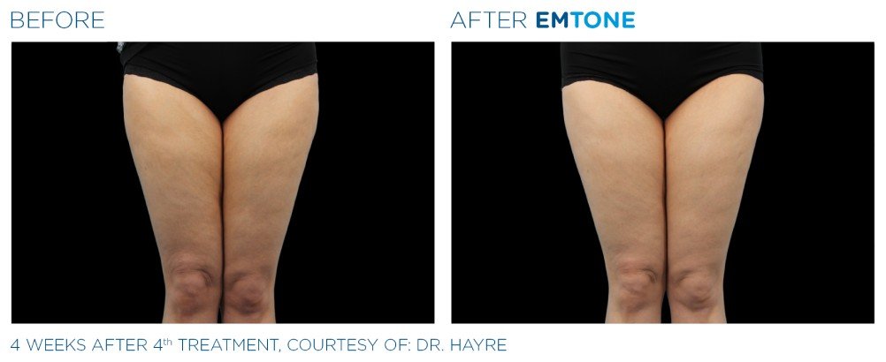 emtone cellulite before and after