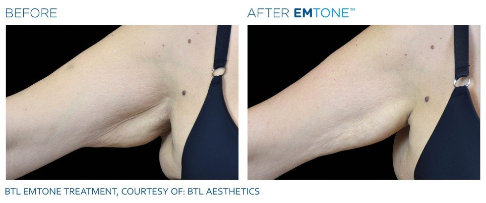 emtone cellulite before and after